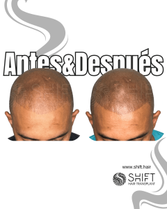 Antes y después de una micropigmentación capilar para un look afeitado en Turquía en SHIFT Hair en Estambul 14 3