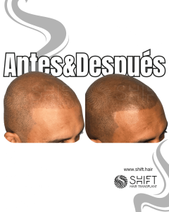 Antes y después de una micropigmentación capilar para un look afeitado en Turquía en SHIFT Hair en Estambul 15 3