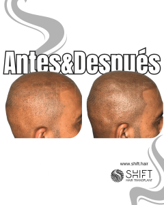 Antes y después de una micropigmentación capilar para un look afeitado en Turquía en SHIFT Hair en Estambul 17 3