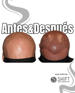 Antes y después de una micropigmentación capilar para un look afeitado en Turquía en SHIFT Hair en Estambul 18 3