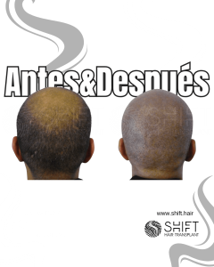 Antes y después de una micropigmentación capilar para un look afeitado en Turquía en SHIFT Hair en Estambul 20 3