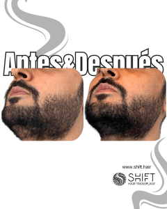 Antes y después de una micropigmentación de barba para un camuflaje de densidad en Turquía en SHIFT Hair en Estambul 02 3