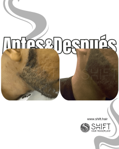 Antes y después de una micropigmentación de barba para un camuflaje de densidad en Turquía en SHIFT Hair en Estambul 03 3