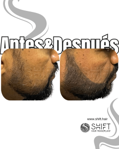 Antes y después de una micropigmentación de barba para un camuflaje de densidad en Turquía en SHIFT Hair en Estambul 06 3