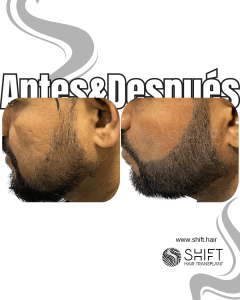 Antes y después de una micropigmentación de barba para un camuflaje de densidad en Turquía en SHIFT Hair en Estambul 07 3