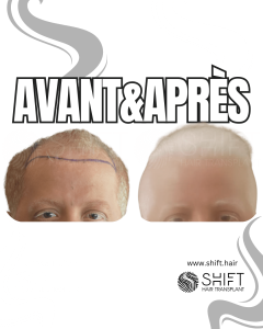 Avant Après de Greffe de Cheveux albinos pour Calvitie Norwood 4 en Turquie chez SHIFT Hair à Istanbul 01 3