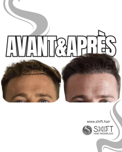 Avant Après de Greffe de Cheveux pour Calvitie Norwood 1 en Turquie chez SHIFT Hair à Istanbul 02 3