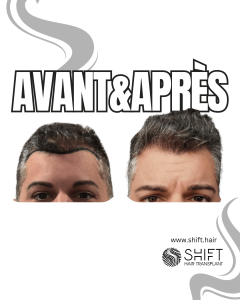 Avant Après de Greffe de Cheveux pour Calvitie Norwood 1 en Turquie chez SHIFT Hair à Istanbul 03 3