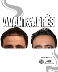 Avant Après de Greffe de Cheveux pour Calvitie Norwood 1 en Turquie chez SHIFT Hair à Istanbul 04 3