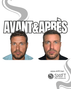 Avant Après de Greffe de Cheveux pour Calvitie Norwood 2 en Turquie chez SHIFT Hair à Istanbul 01 3