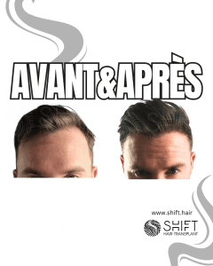 Avant Après de Greffe de Cheveux pour Calvitie Norwood 2 en Turquie chez SHIFT Hair à Istanbul 02 3