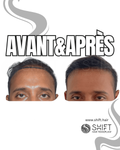 Avant Après de Greffe de Cheveux pour Calvitie Norwood 2 en Turquie chez SHIFT Hair à Istanbul 03 3