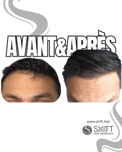 Avant Après de Greffe de Cheveux pour Calvitie Norwood 2 en Turquie chez SHIFT Hair à Istanbul 04 3
