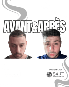 Avant Après de Greffe de Cheveux pour Calvitie Norwood 2 en Turquie chez SHIFT Hair à Istanbul 06 3