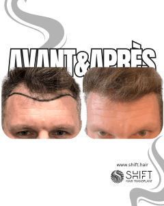 Avant Après de Greffe de Cheveux pour Calvitie Norwood 2 en Turquie chez SHIFT Hair à Istanbul 08 3