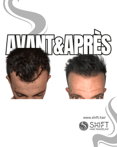 Avant Après de Greffe de Cheveux pour Calvitie Norwood 2 en Turquie chez SHIFT Hair à Istanbul 09 3