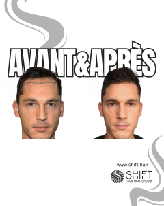 Avant Après de Greffe de Cheveux pour Calvitie Norwood 3 en Turquie chez SHIFT Hair à Istanbul 04 3