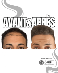 Avant Après de Greffe de Cheveux pour Calvitie Norwood 3 en Turquie chez SHIFT Hair à Istanbul 06 3
