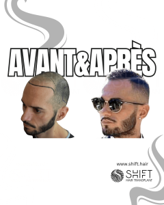 Avant Après de Greffe de Cheveux pour Calvitie Norwood 3 en Turquie chez SHIFT Hair à Istanbul 08 3
