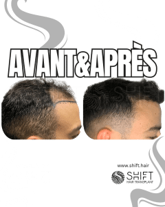 Avant Après de Greffe de Cheveux pour Calvitie Norwood 3 en Turquie chez SHIFT Hair à Istanbul 12 3