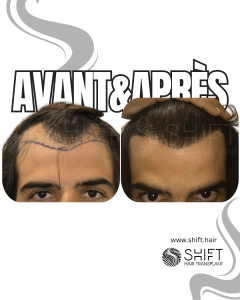Avant Après de Greffe de Cheveux pour Calvitie Norwood 3 en Turquie chez SHIFT Hair à Istanbul 13 3