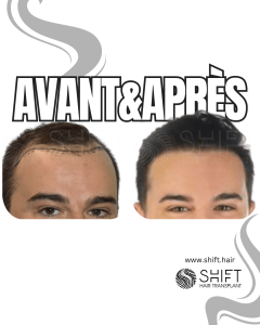 Avant Après de Greffe de Cheveux pour Calvitie Norwood 3 en Turquie chez SHIFT Hair à Istanbul 14 3
