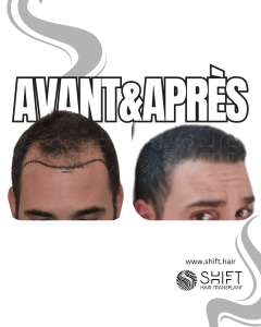 Avant Après de Greffe de Cheveux pour Calvitie Norwood 3 en Turquie chez SHIFT Hair à Istanbul 15 3