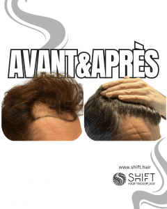 Avant Après de Greffe de Cheveux pour Calvitie Norwood 3 en Turquie chez SHIFT Hair à Istanbul 18 3