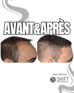 Avant Après de Greffe de Cheveux pour Calvitie Norwood 3 en Turquie chez SHIFT Hair à Istanbul 21 3