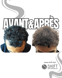 Avant Après de Greffe de Cheveux pour Calvitie Norwood 3 en Turquie chez SHIFT Hair à Istanbul 23 3