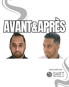Avant Après de Greffe de Cheveux pour Calvitie Norwood 3 en Turquie chez SHIFT Hair à Istanbul 24 3