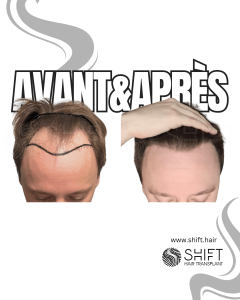 Avant Après de Greffe de Cheveux pour Calvitie Norwood 3 en Turquie chez SHIFT Hair à Istanbul 25 3