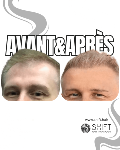 Avant Après de Greffe de Cheveux pour Calvitie Norwood 3 en Turquie chez SHIFT Hair à Istanbul 27 3