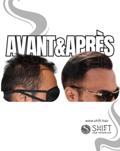 Avant Après de Greffe de Cheveux pour Calvitie Norwood 3 en Turquie chez SHIFT Hair à Istanbul 29 3