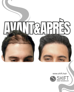 Avant Après de Greffe de Cheveux pour Calvitie Norwood 4 en Turquie chez SHIFT Hair à Istanbul 01 3