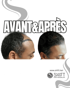 Avant Après de Greffe de Cheveux pour Calvitie Norwood 4 en Turquie chez SHIFT Hair à Istanbul 02 3