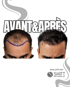Avant Après de Greffe de Cheveux pour Calvitie Norwood 4 en Turquie chez SHIFT Hair à Istanbul 04 3