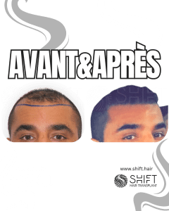 Avant Après de Greffe de Cheveux pour Calvitie Norwood 4 en Turquie chez SHIFT Hair à Istanbul 05 3