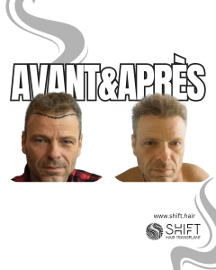 Avant Après de Greffe de Cheveux pour Calvitie Norwood 4 en Turquie chez SHIFT Hair à Istanbul 07 3