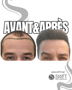 Avant Après de Greffe de Cheveux pour Calvitie Norwood 4 en Turquie chez SHIFT Hair à Istanbul 08 3