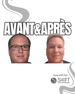 Avant Après de Greffe de Cheveux pour Calvitie Norwood 4 en Turquie chez SHIFT Hair à Istanbul 09 3