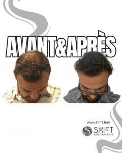 Avant Après de Greffe de Cheveux pour Calvitie Norwood 4 en Turquie chez SHIFT Hair à Istanbul 12 3