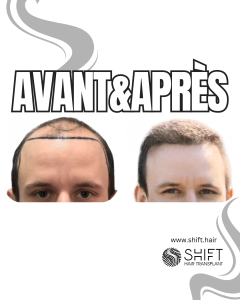 Avant Après de Greffe de Cheveux pour Calvitie Norwood 4 en Turquie chez SHIFT Hair à Istanbul 13 3