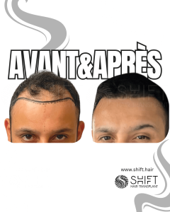 Avant Après de Greffe de Cheveux pour Calvitie Norwood 4 en Turquie chez SHIFT Hair à Istanbul 14 3