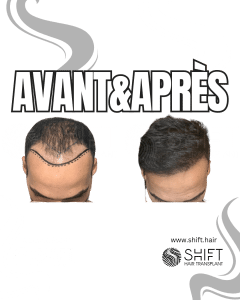 Avant Après de Greffe de Cheveux pour Calvitie Norwood 4 en Turquie chez SHIFT Hair à Istanbul 15 3
