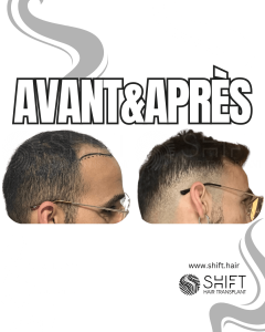 Avant Après de Greffe de Cheveux pour Calvitie Norwood 4 en Turquie chez SHIFT Hair à Istanbul 16 3