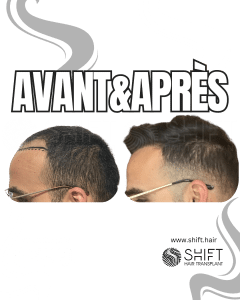 Avant Après de Greffe de Cheveux pour Calvitie Norwood 4 en Turquie chez SHIFT Hair à Istanbul 17 3