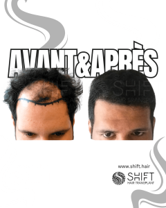 Avant Après de Greffe de Cheveux pour Calvitie Norwood 4 en Turquie chez SHIFT Hair à Istanbul 18 3