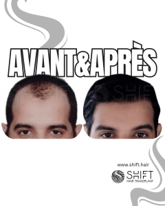 Avant Après de Greffe de Cheveux pour Calvitie Norwood 4 en Turquie chez SHIFT Hair à Istanbul 19 3