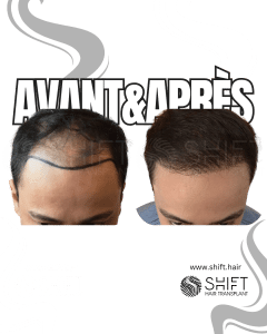 Avant Après de Greffe de Cheveux pour Calvitie Norwood 4 en Turquie chez SHIFT Hair à Istanbul 20 3